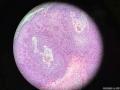 孔祥田老师病例讨论:23 yo F axilla, right, skin tag, bx. Dx?已点评图7