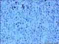 左侧腹股沟区肿物图1