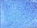 左侧腹股沟区肿物图15
