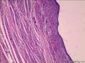 右侧腹股管肿物图1