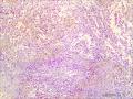 左侧腹股沟区肿物图29
