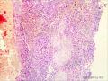 左侧腹股沟区肿物图27