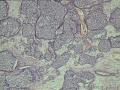 少见病例，双侧卵巢，什么呢？图15