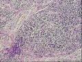 颞部皮下肿物半年图8