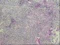 颞部皮下肿物半年图4