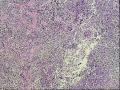 颞部皮下肿物半年图3
