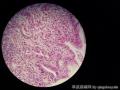 胃体上部前壁近贲门口处深溃疡图6