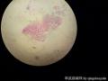胃体上部前壁近贲门口处深溃疡图8