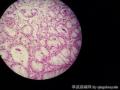 胃体上部前壁近贲门口处深溃疡图11