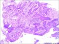 52岁，全切子宫，宫颈腺上皮是成熟鳞化吗？请老师们回复图2
