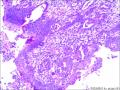 52岁，全切子宫，宫颈腺上皮是成熟鳞化吗？请老师们回复图5