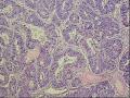 子宫内膜样腺癌还是粘液性囊腺癌图7