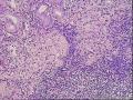 胃镜考虑淋巴瘤，麻烦老师看看图13