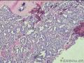 甲状腺肿大图5