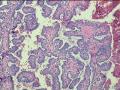 甲状腺肿大图3