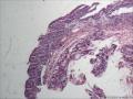 鼻前庭囊肿，粘液腺囊肿吗？图3
