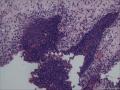 膀胱粘膜，临床疑癌，请各位老师看看。图9