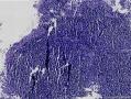 鼻咽部肿物。1、非角化性鳞状细胞癌？2、炎症性改变？3、淋巴瘤？图6