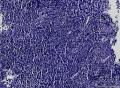 鼻咽部肿物。1、非角化性鳞状细胞癌？2、炎症性改变？3、淋巴瘤？图7