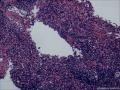 请各位老师帮看看这个鼻腔肿物图17