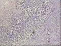求助，甲状腺峡部肿物怎么报啊图1