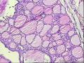 求助，甲状腺左叶怎么报啊？图9