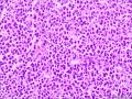 腹腔肿物：淀粉样变和浆细胞比较突出？图21
