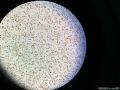 免疫组化腋窝淋巴结多枚图5
