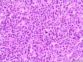 腹腔肿物：淀粉样变和浆细胞比较突出？图20