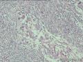 恶纤组？皮隆突？恶纤组型皮隆突？图24