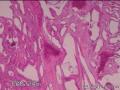 下腹包块，转移性腺癌？图4