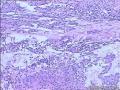 甲状腺包块图11