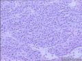 甲状腺包块图4