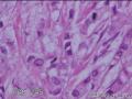 乳腺浸润性导管癌？小叶癌？图6