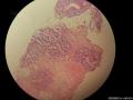 乳腺穿刺标本  腺样囊性癌or浸润性导管癌？图4