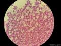 乳腺穿刺标本  腺样囊性癌or浸润性导管癌？图9