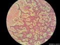 乳腺穿刺标本  腺样囊性癌or浸润性导管癌？图8