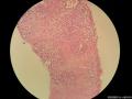 乳腺穿刺标本  腺样囊性癌or浸润性导管癌？图6