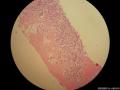 乳腺穿刺标本  腺样囊性癌or浸润性导管癌？图3