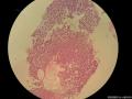 乳腺穿刺标本  腺样囊性癌or浸润性导管癌？图5