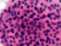 甲状腺穿刺图4