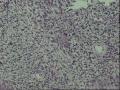 左前臂肌层实性肿物图13