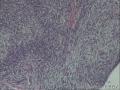 空肠肿物？恶性间质瘤？图1
