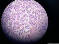 甲状腺肿物图5