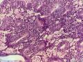 微信病例8｜高分化子宫内膜样癌图5