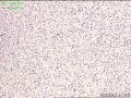 腹壁肿物，请教？图2