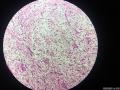 微信病例9｜结节性筋膜炎图14