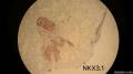 微信病例18   63 yo M lung nodules.图2