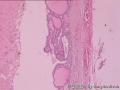 甲状腺囊腺瘤？图4