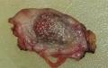 耳后皮肤毛发腺瘤？图12